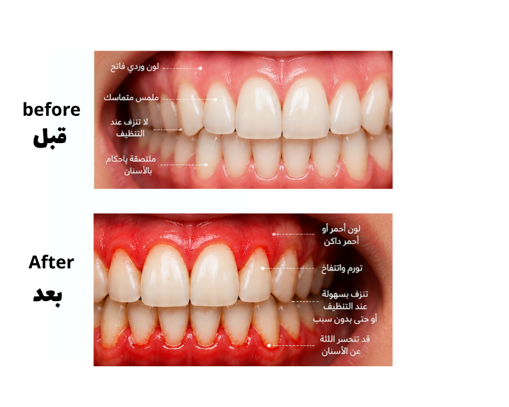 Gum Inflammation (Gingivitis)
